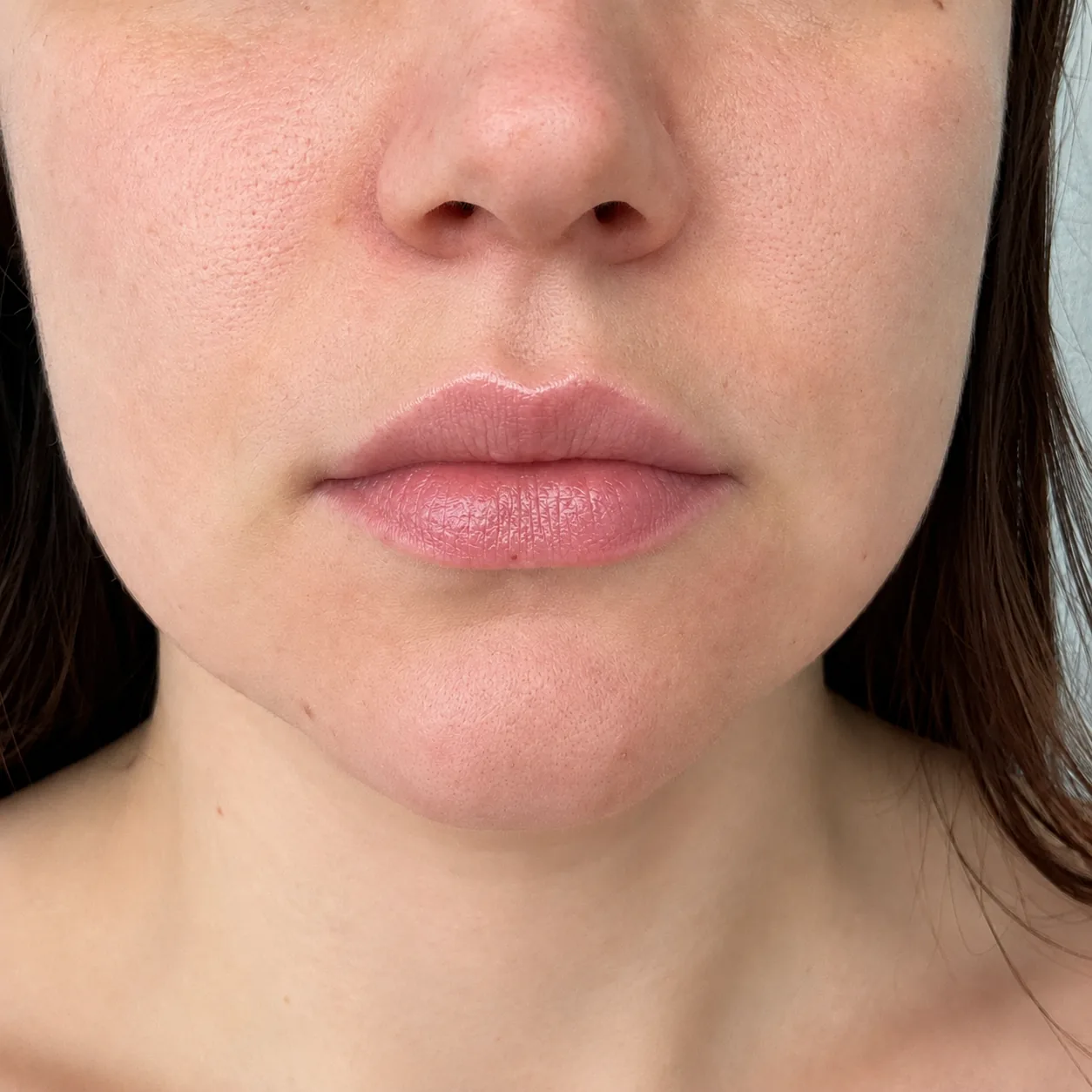 Lip filler result